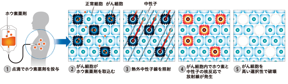 ホウ素中性子捕捉療法イメージ